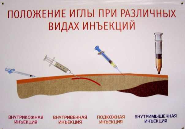 Положение иглы при различных видах иньекции