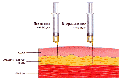 мильгамма уколы