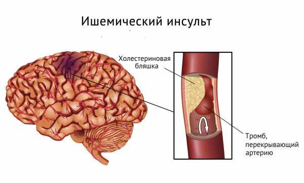 Цераксон