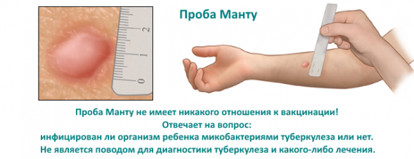 Проба манту для детей