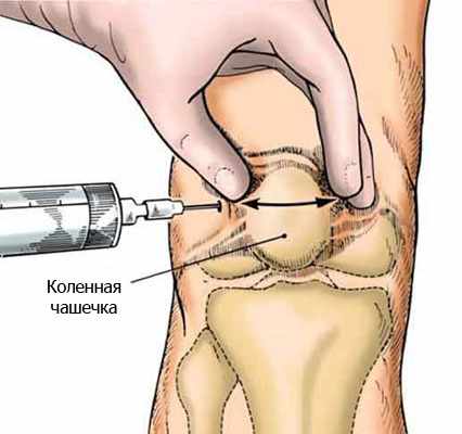 дипроспан уколы инструкция по применению