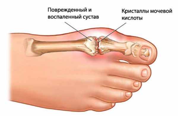 кетопрофен инструкция по применению уколы