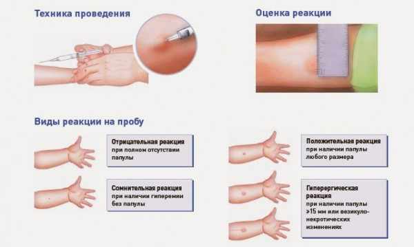 Таблица Манту