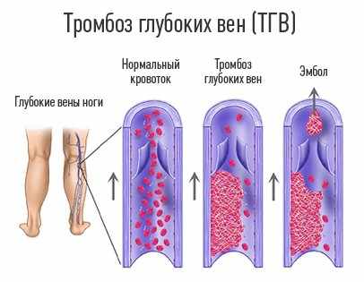 Гепарин (уколы)