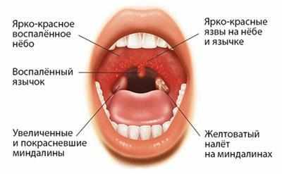 Проявление герпесной ангины
