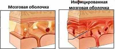 Оболочка мозга при менингите