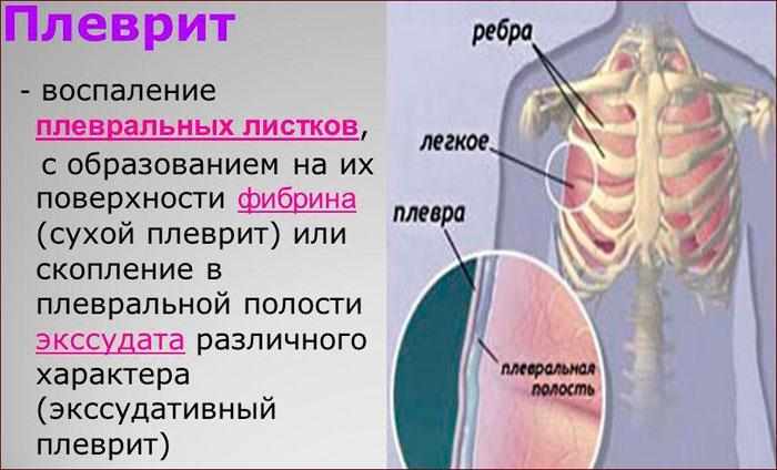 Что такое плеврит
