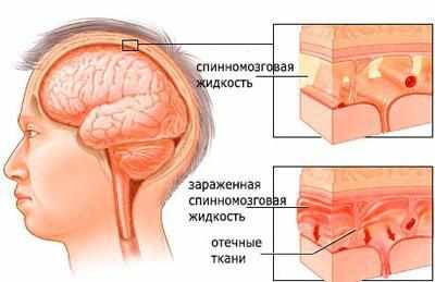 Проявление менингита