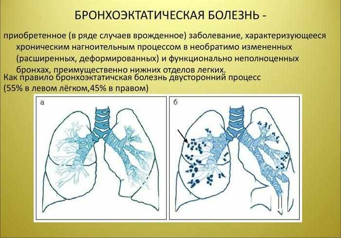 Бронхоэктатическая болезнь: определение, признаки.