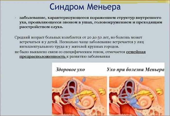 Синдром Меньера