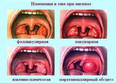 Виды ангины