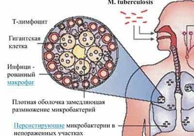 Признаки туберкулеза