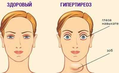 Симптомы гипертериоза