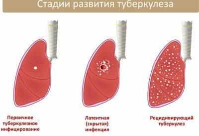 Формы туберкулеза