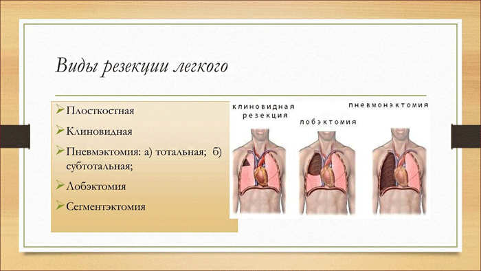 виды резекции легкого