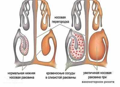 Вазомоторный ринит