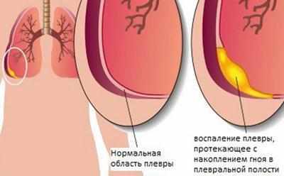 Эмпиема плевры