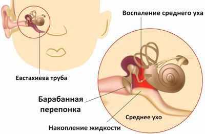Отит среднего уха