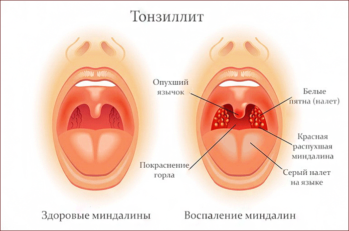 симптомы тонзиллита