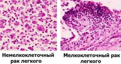 Отличие мелкоклеточного рака от немелкоклеточного