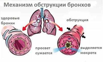 Обструктивный бронхит