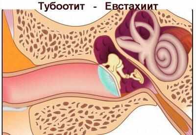 Барабанная перепонка при тубоотите