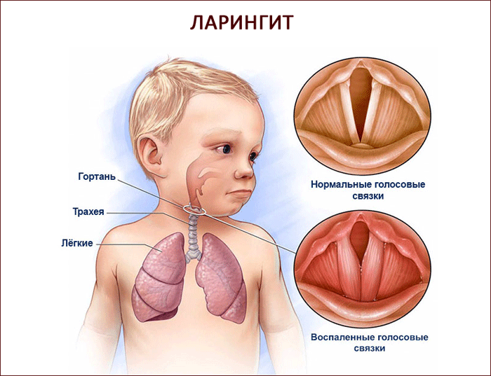 признаки ларингита
