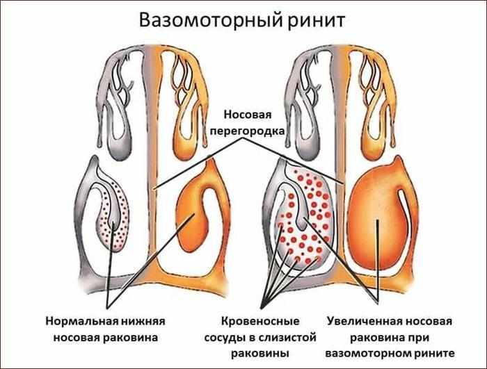 вазомоторный ринит