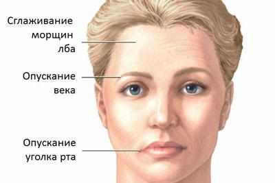 Паралич лицевого нерва