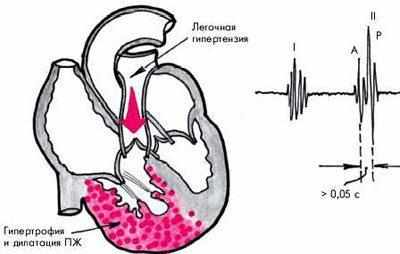 Легочное сердце