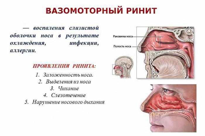 Симптомы вазомоторного ринита