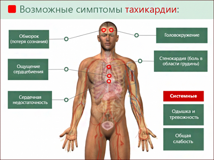 симптомы тахикардии