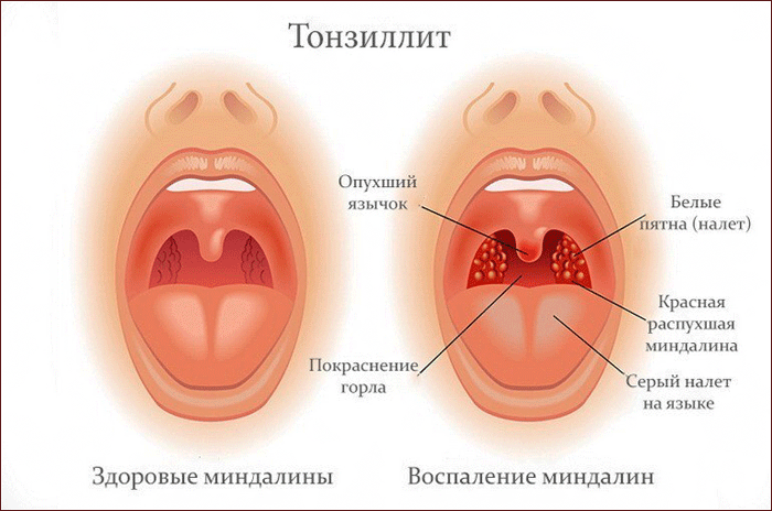 симптомы тонзиллита