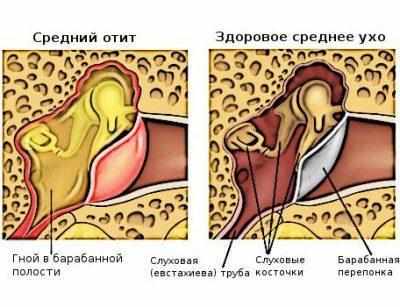 Средний отит