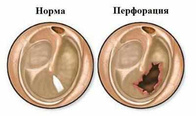 Перфорация барабанной перепонки