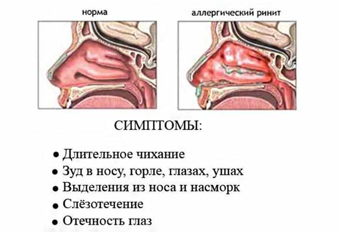 Симптомы аллергического ринита