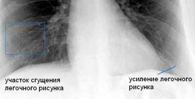Усиление легочного рисунка
