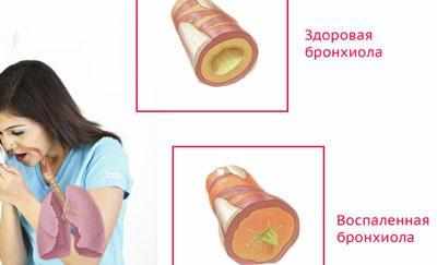 Острый бронхит