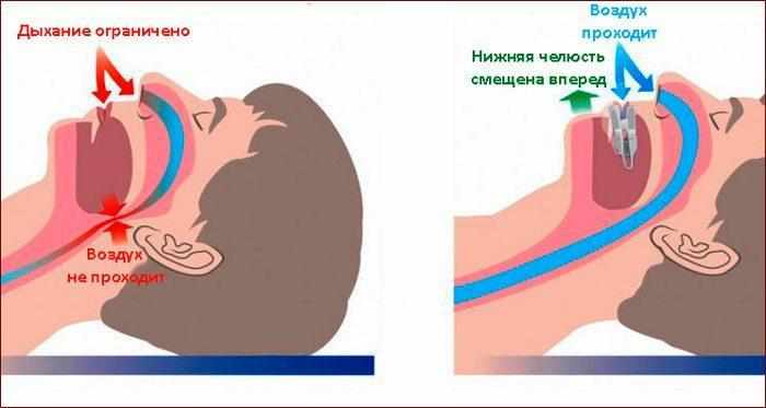 Применение антихрапа