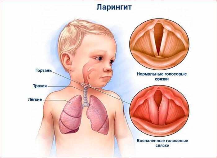 ларингит у детей