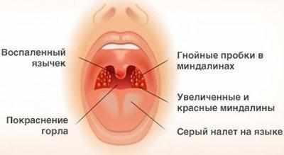 Признаки ангины