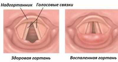 Связки при ларингите
