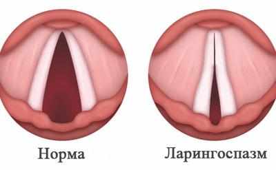 Признак ларингоспазма