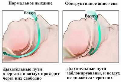 Синдром обструктивного апноэ