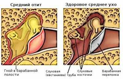 Отит среднего уха