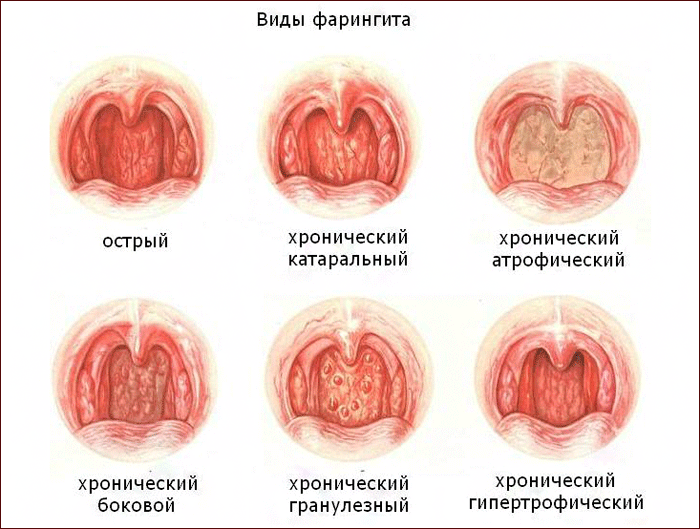 Виды фарингита