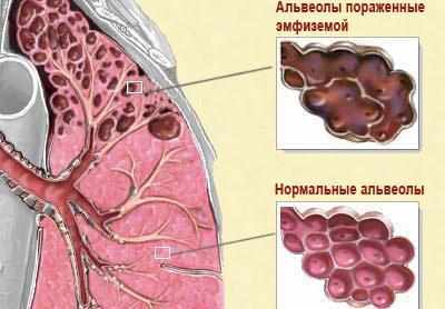 Эмфизема легких
