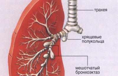 Проявление бронхоэктаза