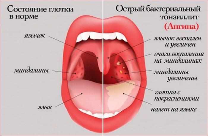 Признаки ангины