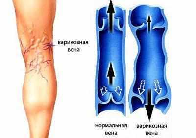 Варикозная болезнь